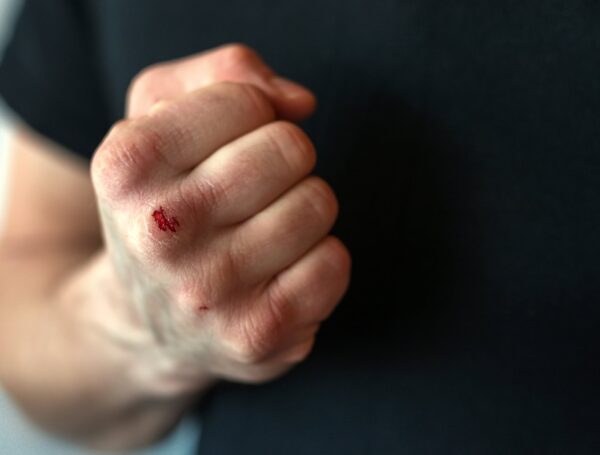 Famous Domestic Violence Cases 1 A man's bloodied fist used to illustrate article about celebrities accused of domestic violence